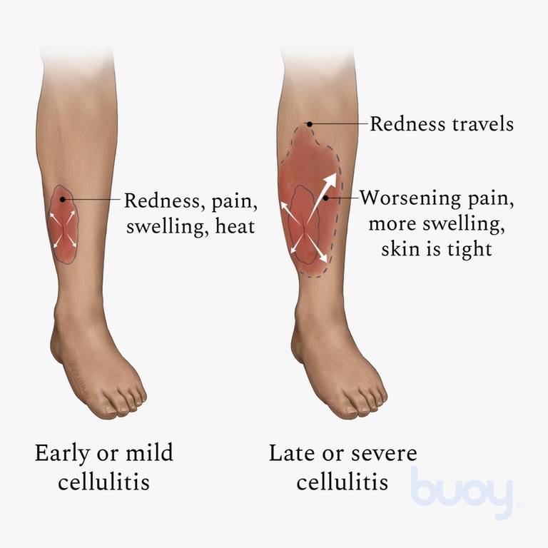 cellulitis bottom of foot