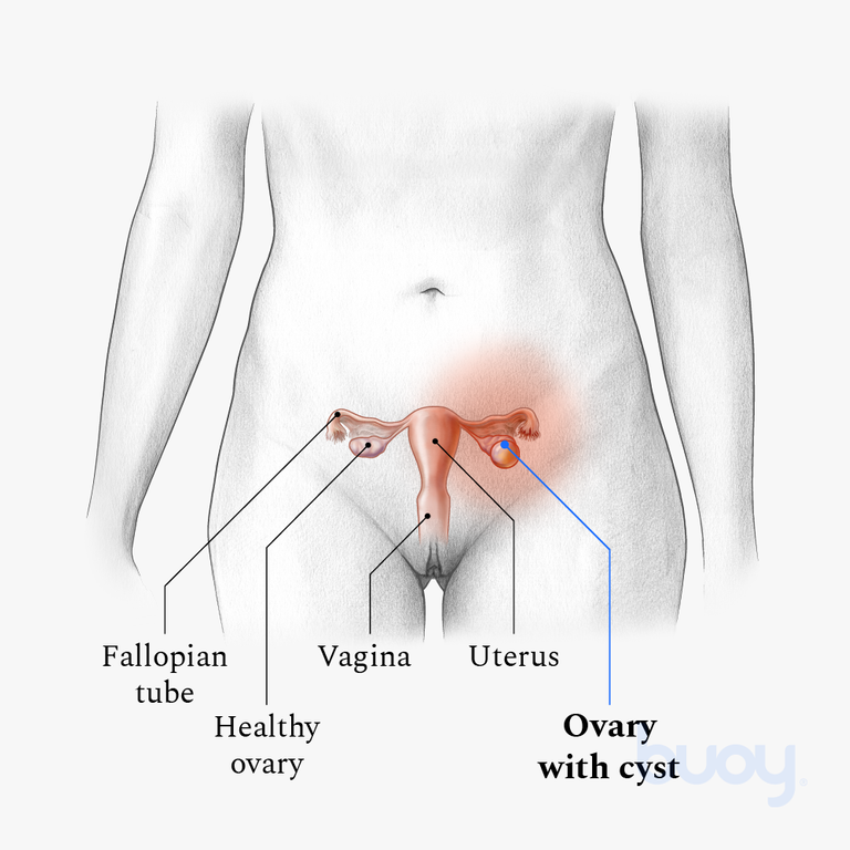 dermoid cyst ovary eye