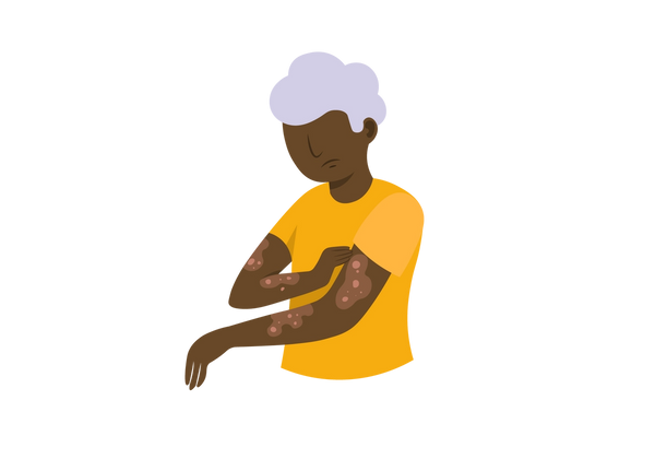 An illustration of a frowning woman from the waist up with her left arm bent in front of her and her right hand scratching at medium brown blotches with pink circles within the splotches on her left arm. She has dark brown skin and short, curly light purple hair. She is wearing a yellow short-sleeved t-shirt.