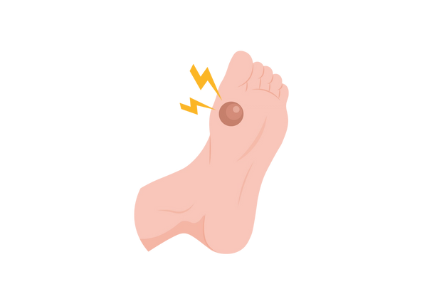 An illustration of the bottom of a light peach-toned foot from a three-quarter angle. There is a large red round blister on the ball of the foot below the big toe. Two yellow lightning bolts come from the spot.