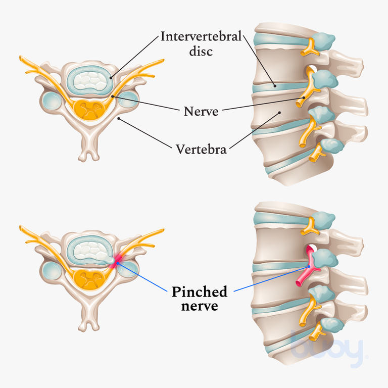 Pinched Nerve Causes Symptoms And How To Get Relief