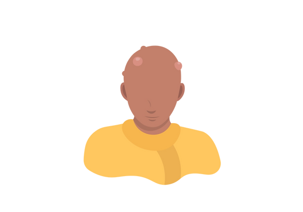 Eine Illustration einer Person, deren Kopf leicht nach unten geneigt ist. Auf ihrer Kopfhaut befinden sich große Beulen. Sie tragen ein gelbes Hemd.