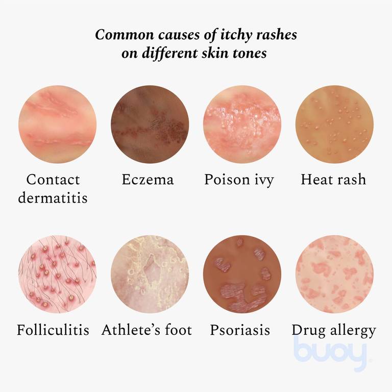 luft klint beslag Top 12 Causes of an Itchy Rash | Buoy Health