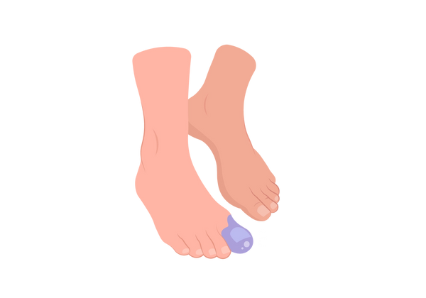 Uma ilustração de dois pés claros em tons de pêssego no meio do passo. O pé da frente tem uma mancha roxa no dedão. O pé de trás tem apenas os dedos e a planta do pé no chão.