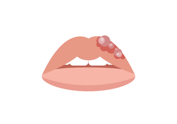 Lábios com herpes labial na parte superior esquerda do lábio superior.