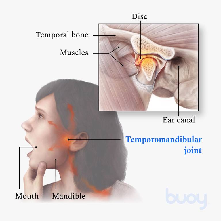 MANDÍBULA ESTALANDO (ESTRALANDO) - Disfunção da articulação  temporomandibular (ATM/DTM) 