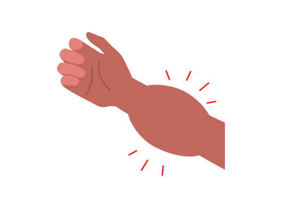 An illustration of an arm coming at a diagonal upwards angle from the right side. The hand is relaxed, and there is a large bulge just below the wrist. Four red lines come from the top of the bulge, and three from below. The skin is medium-dark peach-toned.
