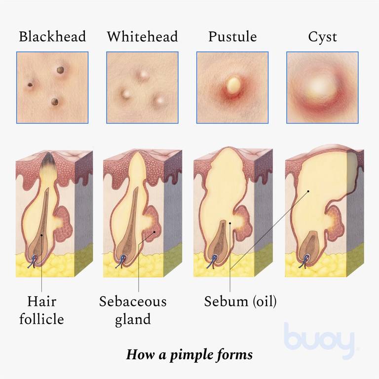 What Causes Pimples & How to Treat Them Fast | Buoy