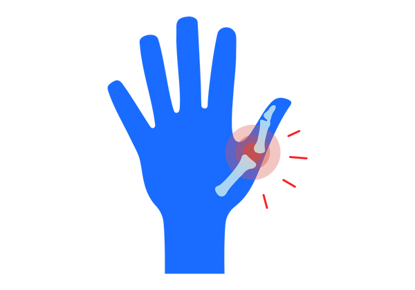 Una ilustración de una mano izquierda azul con los dedos extendidos. Los huesos de color azul claro son visibles a través de la piel del pulgar y hay un gran espacio entre dos de ellos. Tres círculos concéntricos rojos salen del espacio entre los huesos y cuatro líneas rojas enfatizan el círculo.