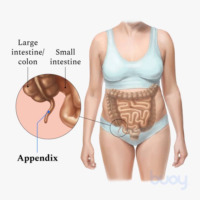 Beautiful Work Info About How To Check For Appendicitis Dancelocation19 Beautiful Work Info About How To Check For Appendicitis Dancelocation19