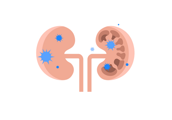 Two pink kidneys. The left one has blue bacteria, the right side has mushroom-shaped holes with blue bacteria over them.