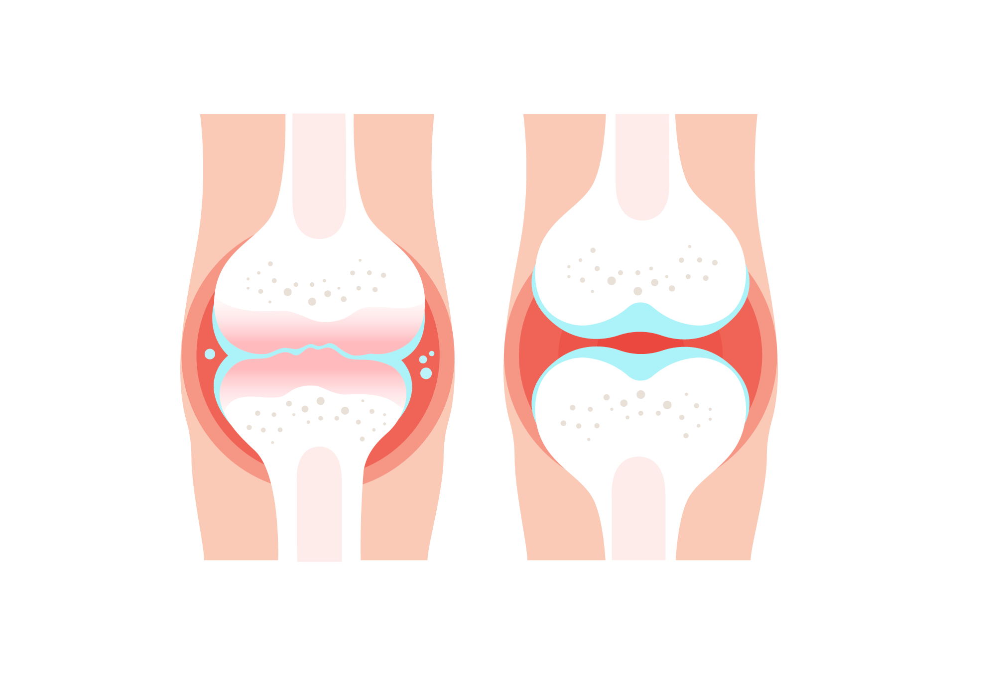 rheumatoid arthritis és osteoarthritis súlyos alsó hátfájás