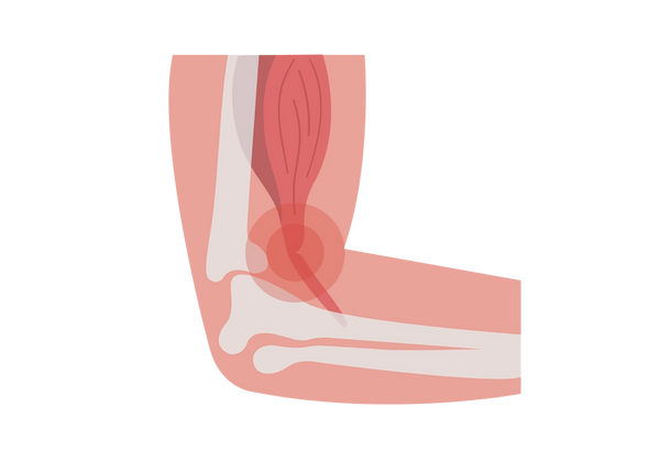 An elbow with a view of the bones and tendons. The tendon is split near the elbow and red concentric circles emanate from it.