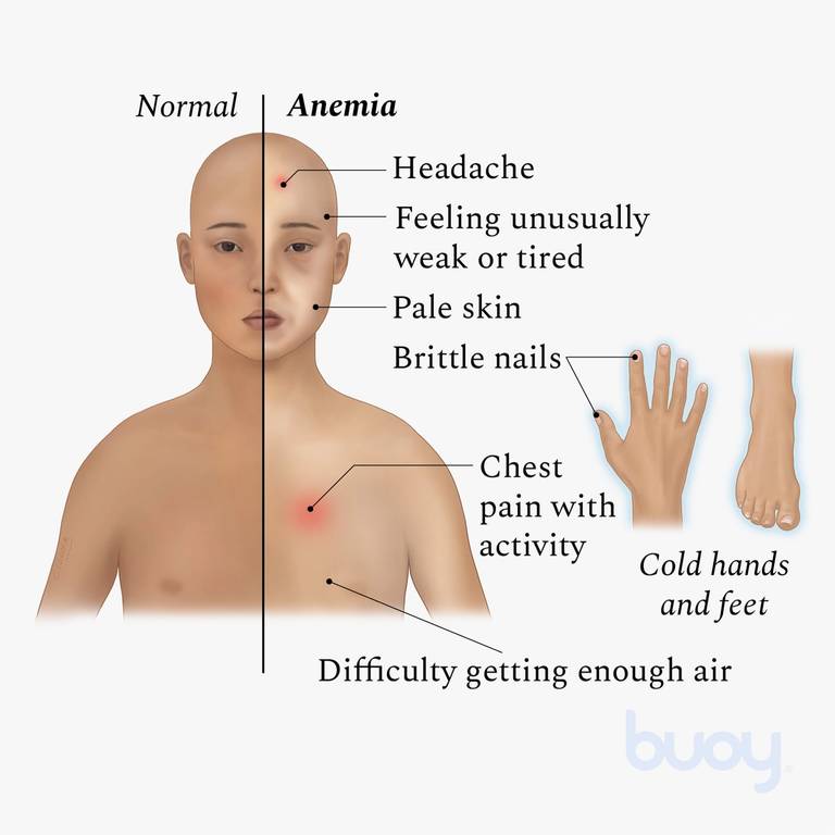 Iron Deficiency Anemia Symptoms