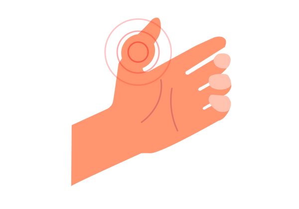 Eine Illustration einer Hand mit der Handfläche nach oben. Die Finger sind natürlich gekrümmt und der Daumen ragt nach oben. Am Daumen befindet sich ein großer geschwollener Bereich, der von drei roten konzentrischen Kreisen umgeben ist, die die Schwellung betonen. Der Rest der Hand ist in einem hellen bis mittleren Pfirsichton gehalten.