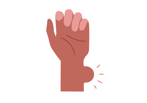 Une illustration d’une main et d’un poignet. Une grosse bosse dépasse du côté du poignet avec quatre lignes rouges qui en émanent.