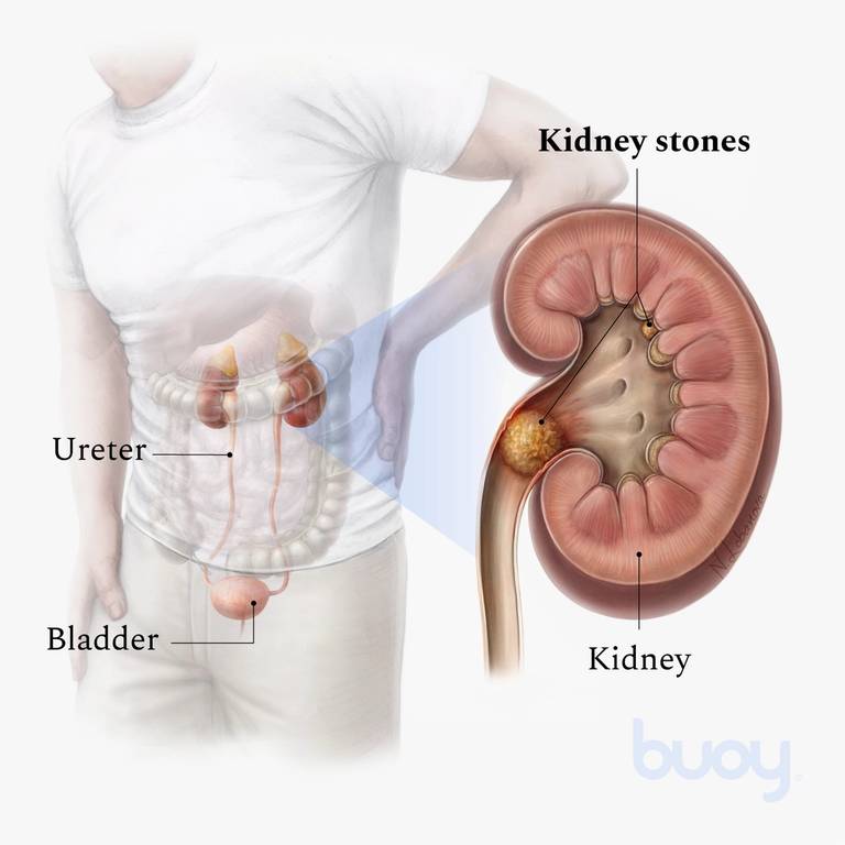 A realistic illustration of a man with his hand on his side towards the back. Visible through his white shirt and pants are realistic kidneys, two labeled "ureter"s, and a labeled "bladder." The ureters connect the kidneys to the bladder. On the right, there is a close-up cross-section of a labeled "kidney." Small yellow balls, labeled "kidney stones," are in the kidney. One is lodged in the entrance to the ureter.