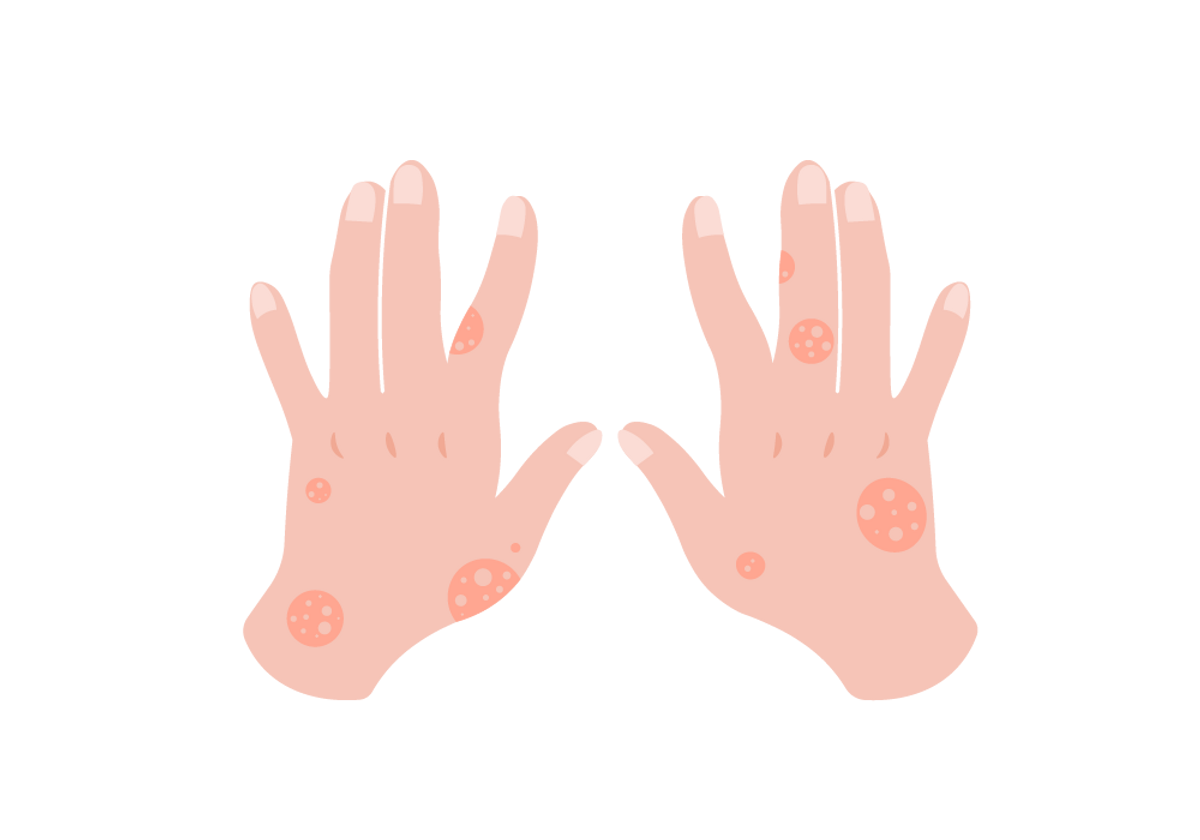 Dr. - A dermatite atópica é uma doença de pele que afeta principalmente as  crianças. A pele atópica tem uma constituição seca com uma “função de  barreira” prejudicada. Alguns alérgenos podem penetrar, image size:1200x840