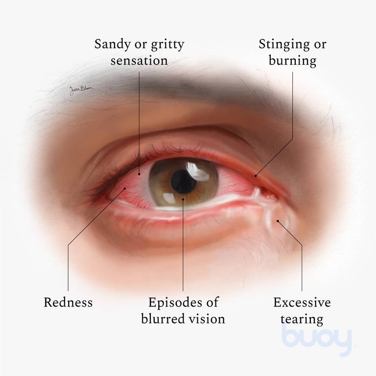Top 9 Causes of Dry Eyes | How Get Relief | Buoy