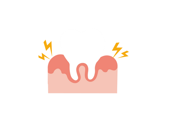 Illustration d’une dent blanche incrustée dans une gencive rose clair avec des taches rose plus foncées vers la surface. Deux éclairs jaunes proviennent des taches rouges sur la gencive de chaque côté de la dent.