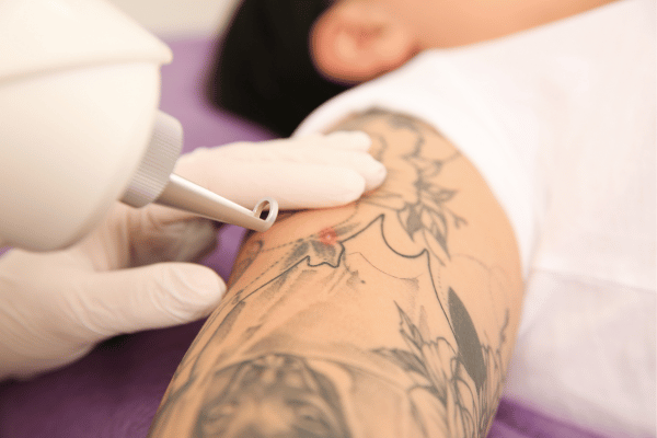 Generalized lichen planus following tattooing with involvement of old  hypertrophic scars: Is it 'Koebner recall?' - Indian Journal of  Dermatology, Venereology and Leprology