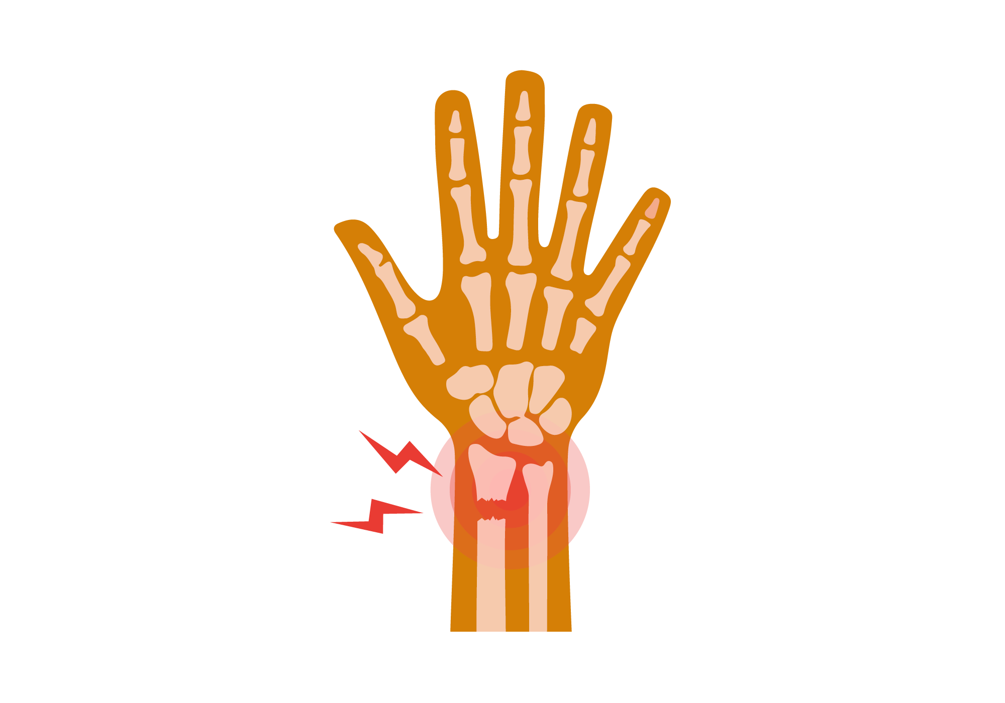 Wrist Fracture | What to Do When You Break Your Wrist | Buoy