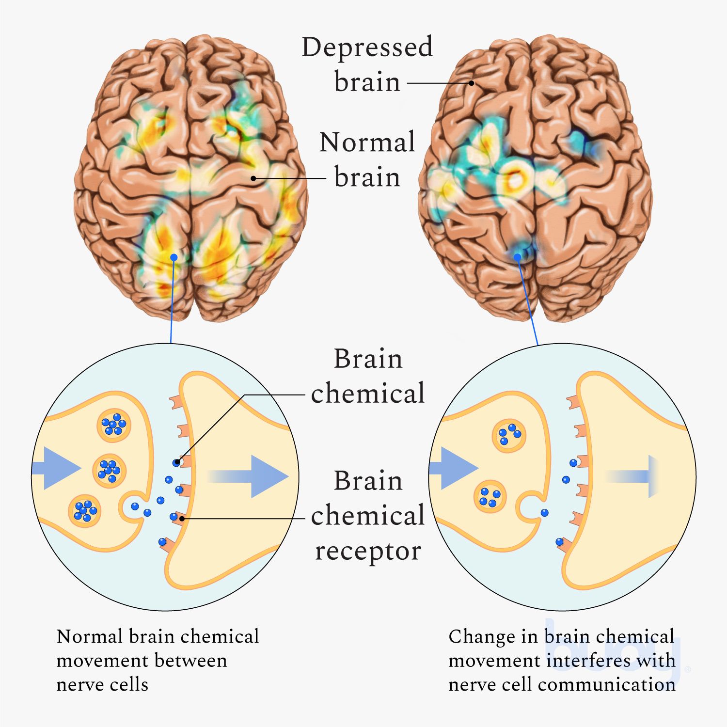 Major Depressive Disorder | Understand Treatments for Depression