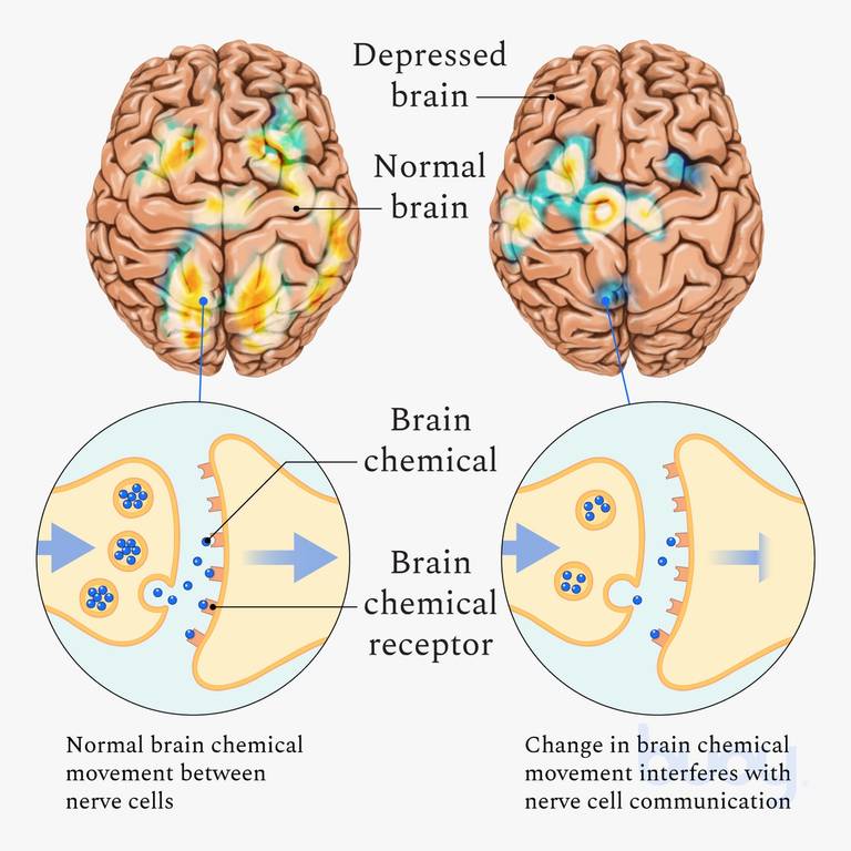 Major Depressive Disorder | Understand Treatments for Depression
