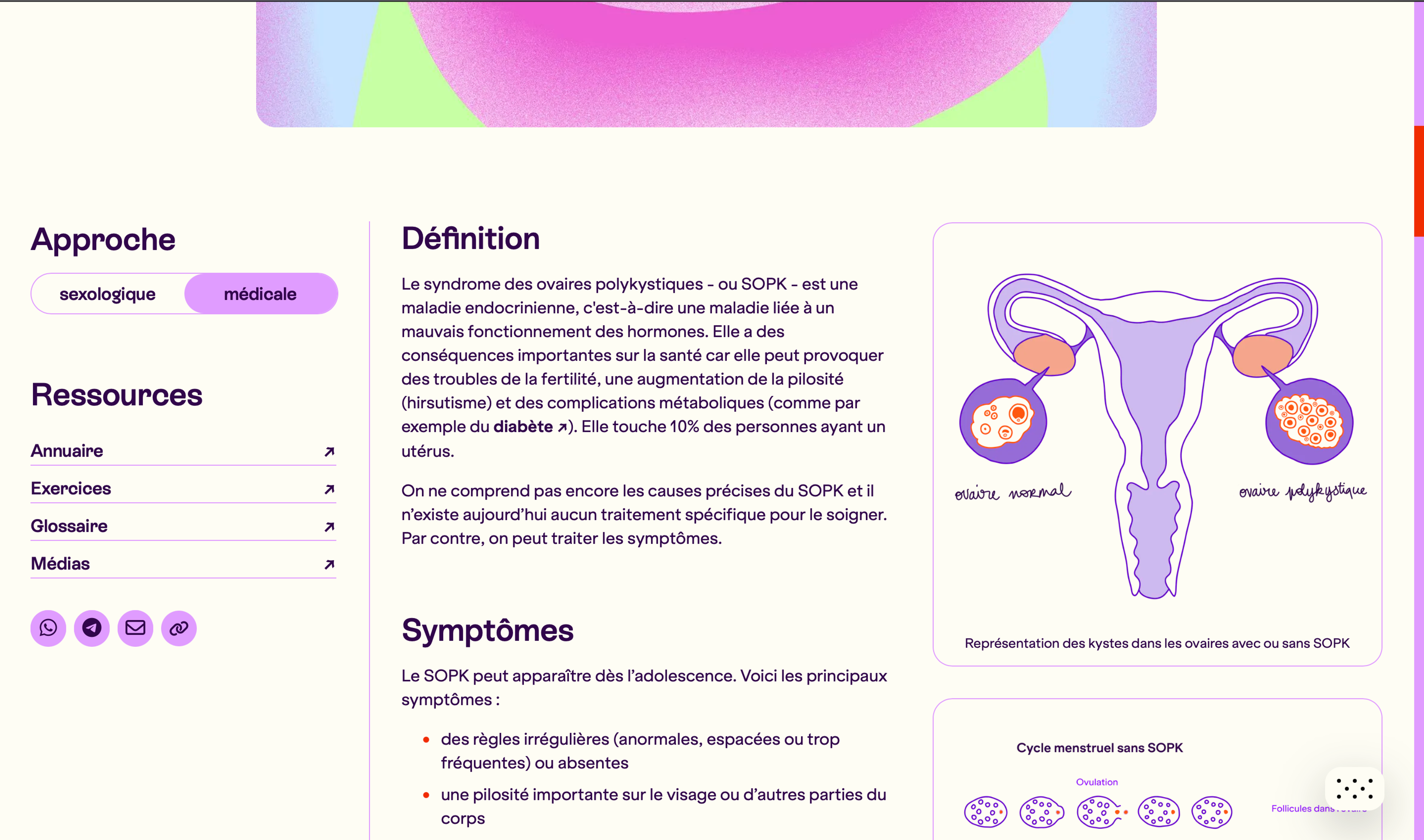 Article on polycystic ovary syndrome. Each article is written with both a medical and a psycho-sexological approach. It also includes diagrams to illustrate certain types of pain, such as the cysts specific to polycystic ovary syndrome shown here.