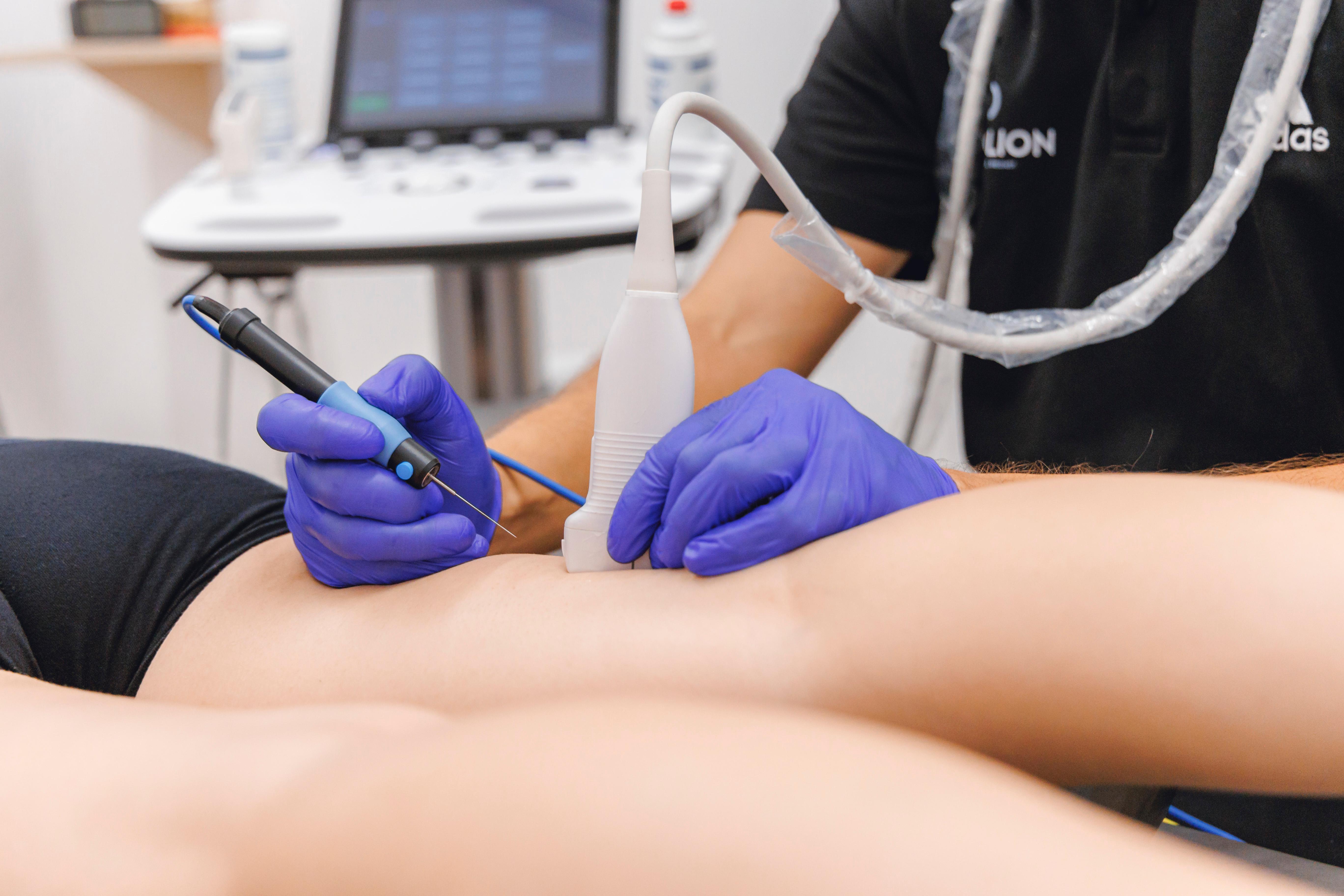 Punción seca en fisioterapia