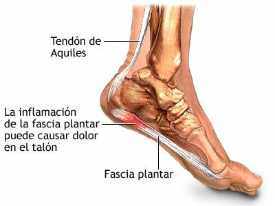 Fascitis plantar