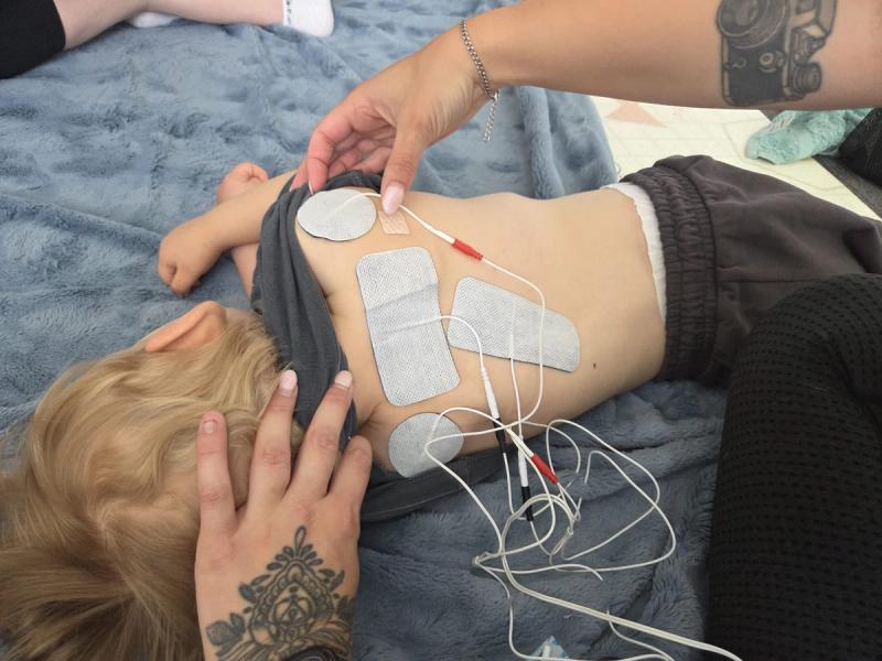 Electrode pads being placed along a child's back before a stimulation session
