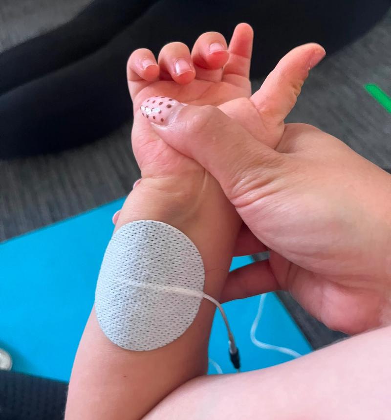 A stimulation electrode on a baby's lower leg, with a therapist supporting the foot
