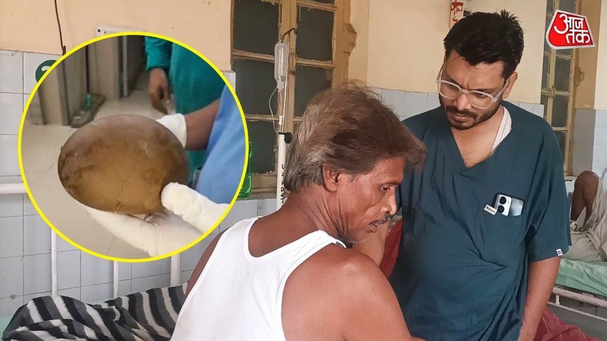 कानपुर में डेढ़ किलो के पत्थर से बवासीर का इलाज करने के दौरान गंभीर हादसा, शरीर के अंदर घुसा पत्थर और डॉक्टरों ने बचाई मरीज की जान