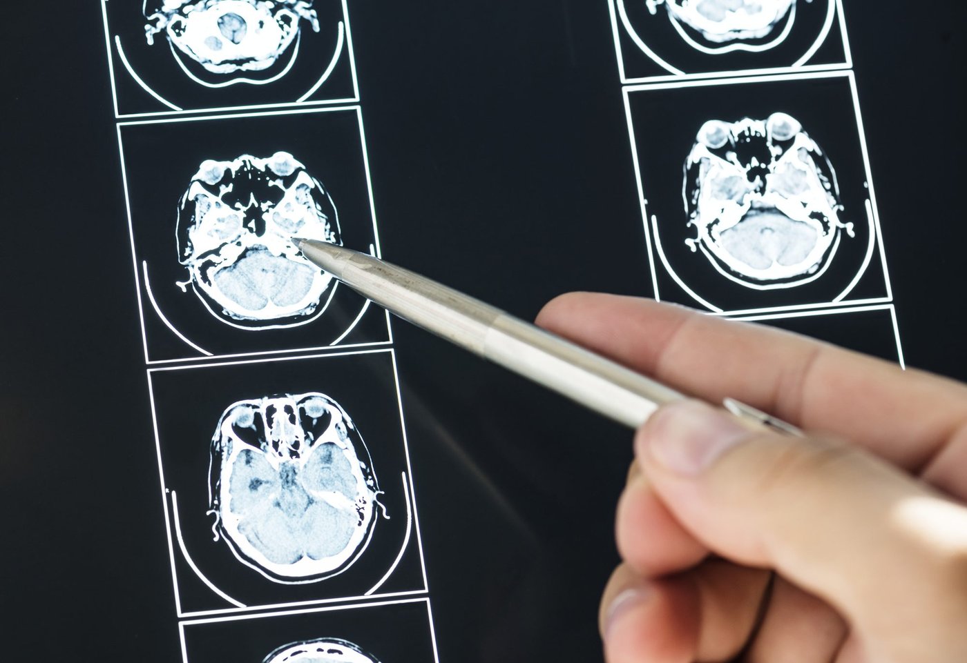 Me encontraron un aneurisma cerebral: ¿qué significa y qué sigue?