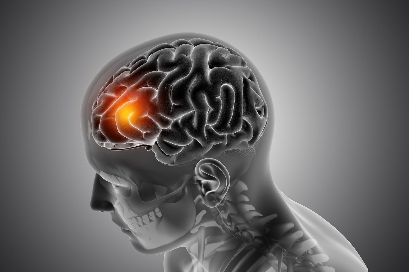 ¿Derrame cerebral, infarto cerebral y aneurisma significan lo mismo?