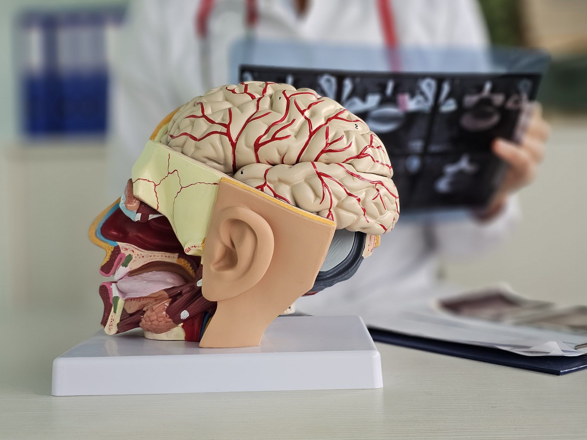 ¿Qué son los coils y cómo se usan para tratar un aneurisma cerebral?