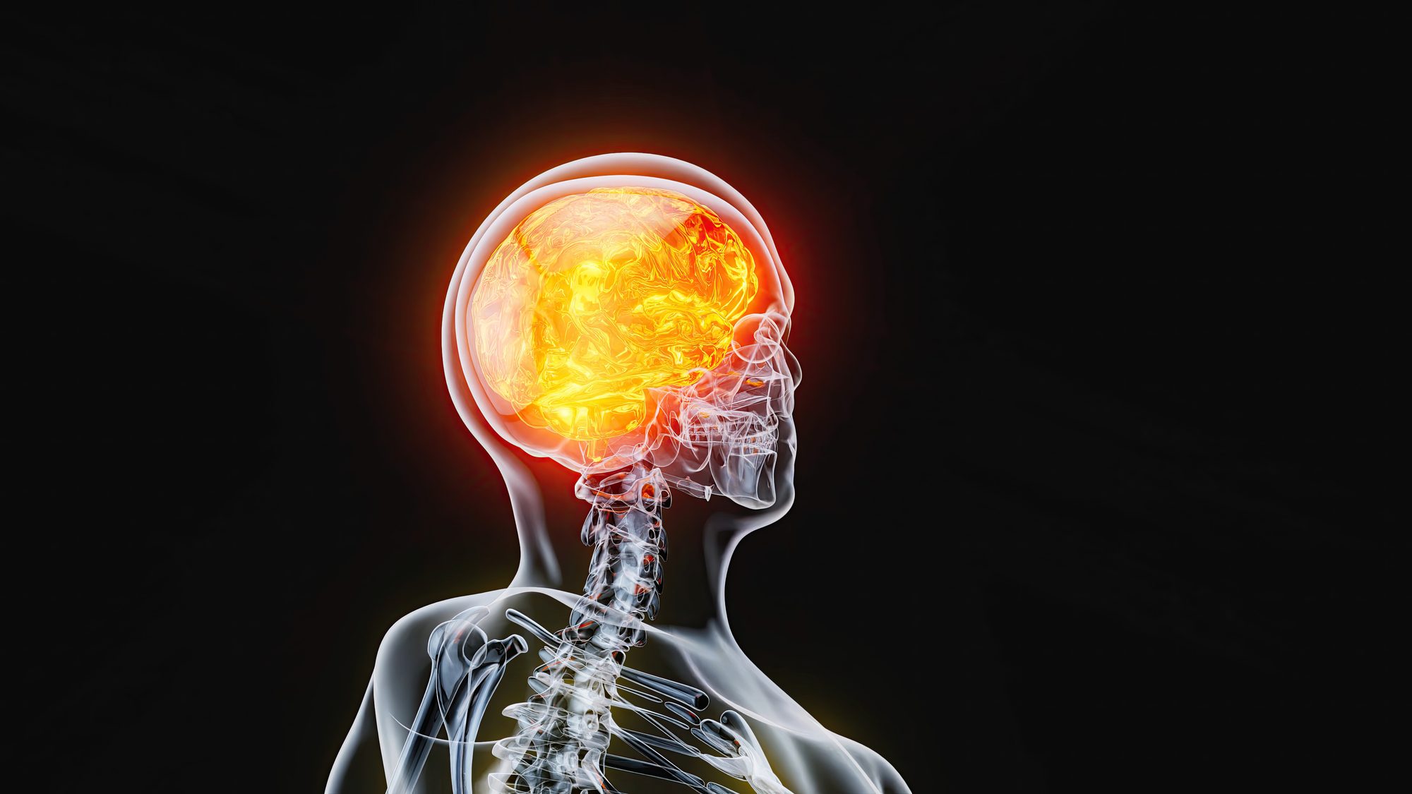 Mi reporte dice aneurisma sacular o fusiforme: ¿qué quiere decir?
