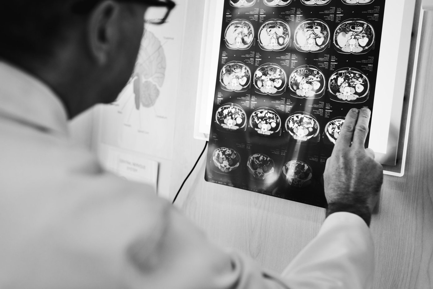 ¿Qué estudios muestran cómo circula la sangre en una MAV cerebral?