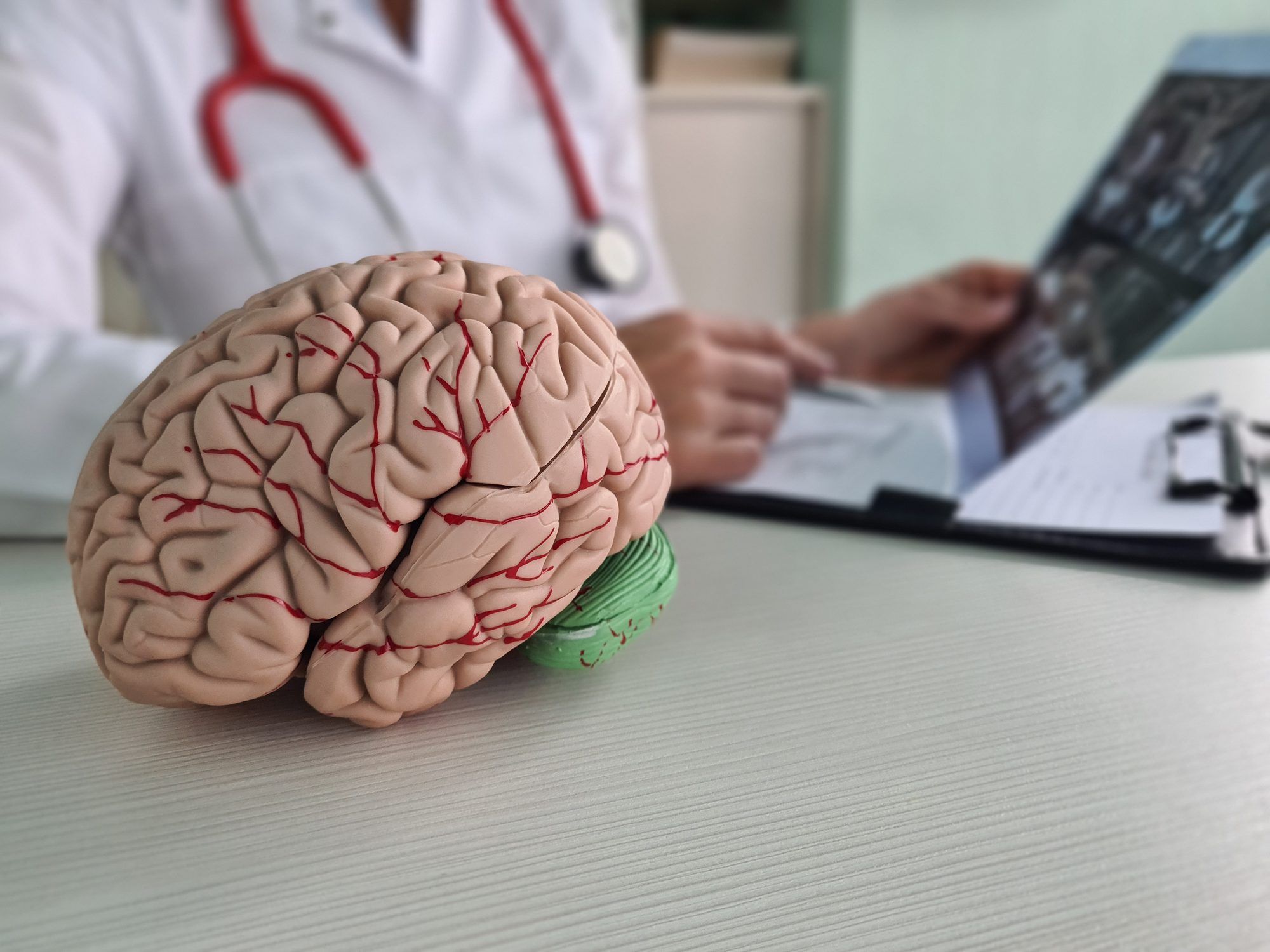¿Cuándo puede ayudar una segunda opinión sobre un aneurisma o una malformación vascular?