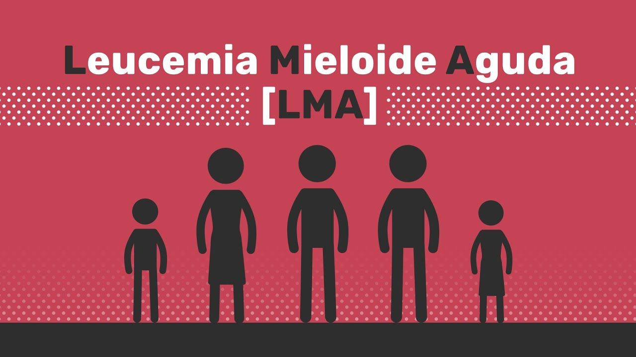 Acute myeloid leukemia: Overview