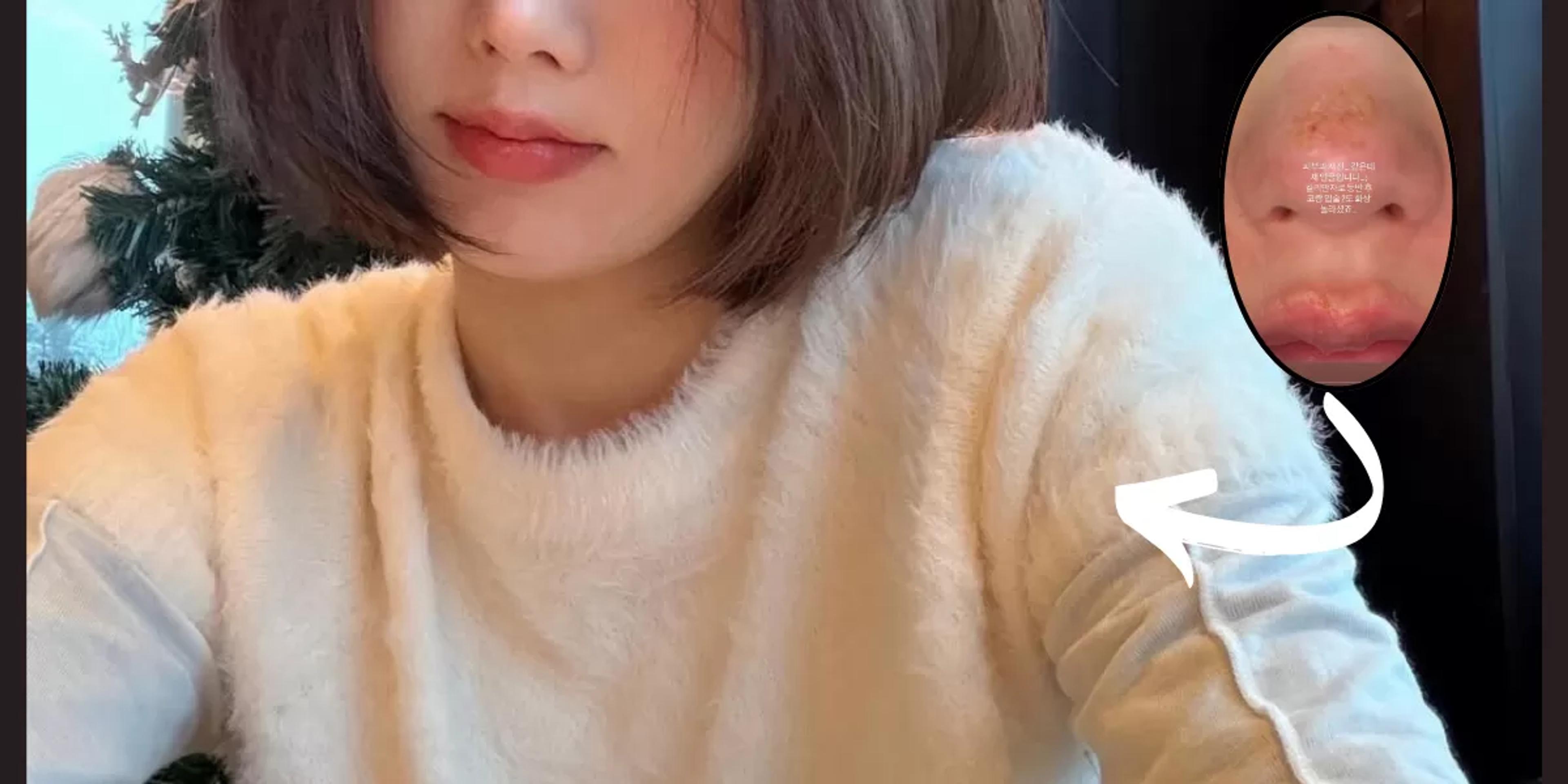 Lekas Sembuh! Salah Satu Idol Kpop Wanita Bagikan Potret Luka Bakar di Wajahnya Usai Mendaki Gunung 