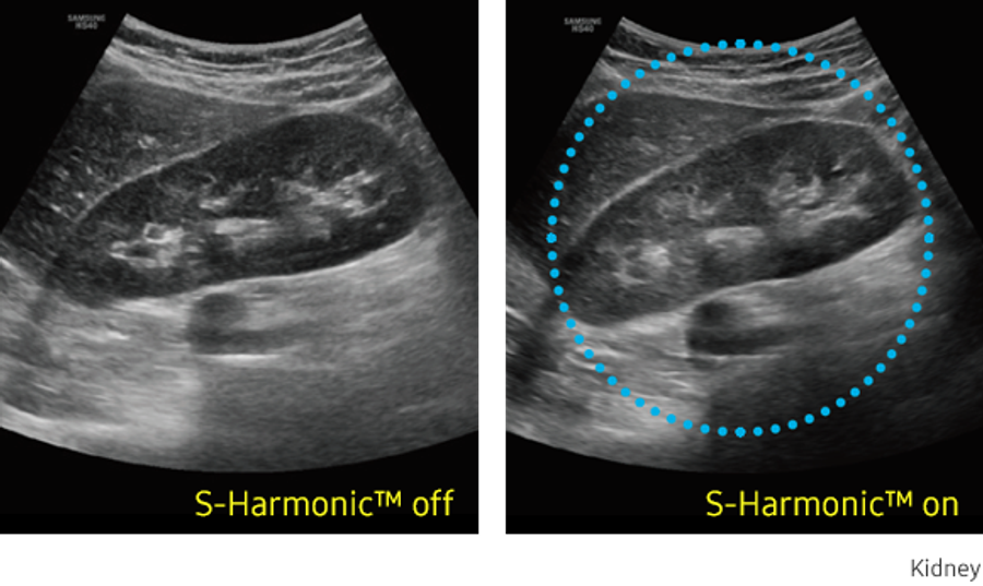 Lysis | Samsung Healthcare | HS40 Ultrasound System