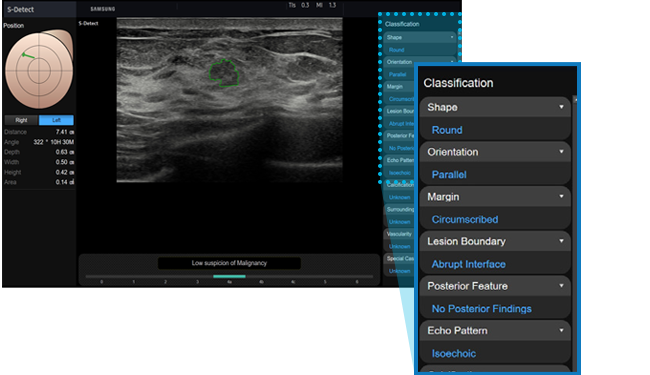 Lysis | Samsung Healthcare | HS40 Ultrasound System