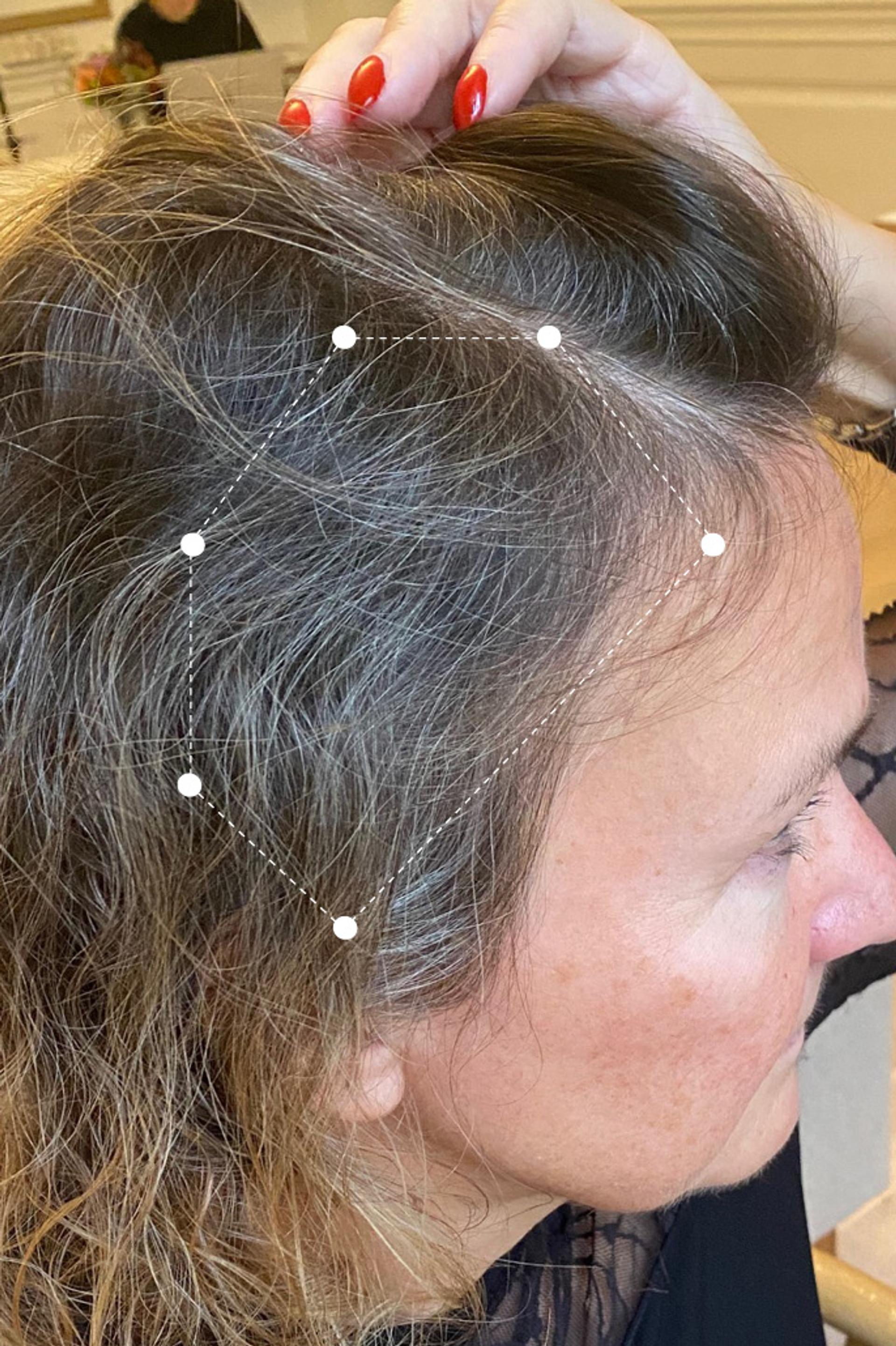 Temple Side of Head  Hair Thinning on Red Head Female Client after using the Harklinikken Extract for 19 months