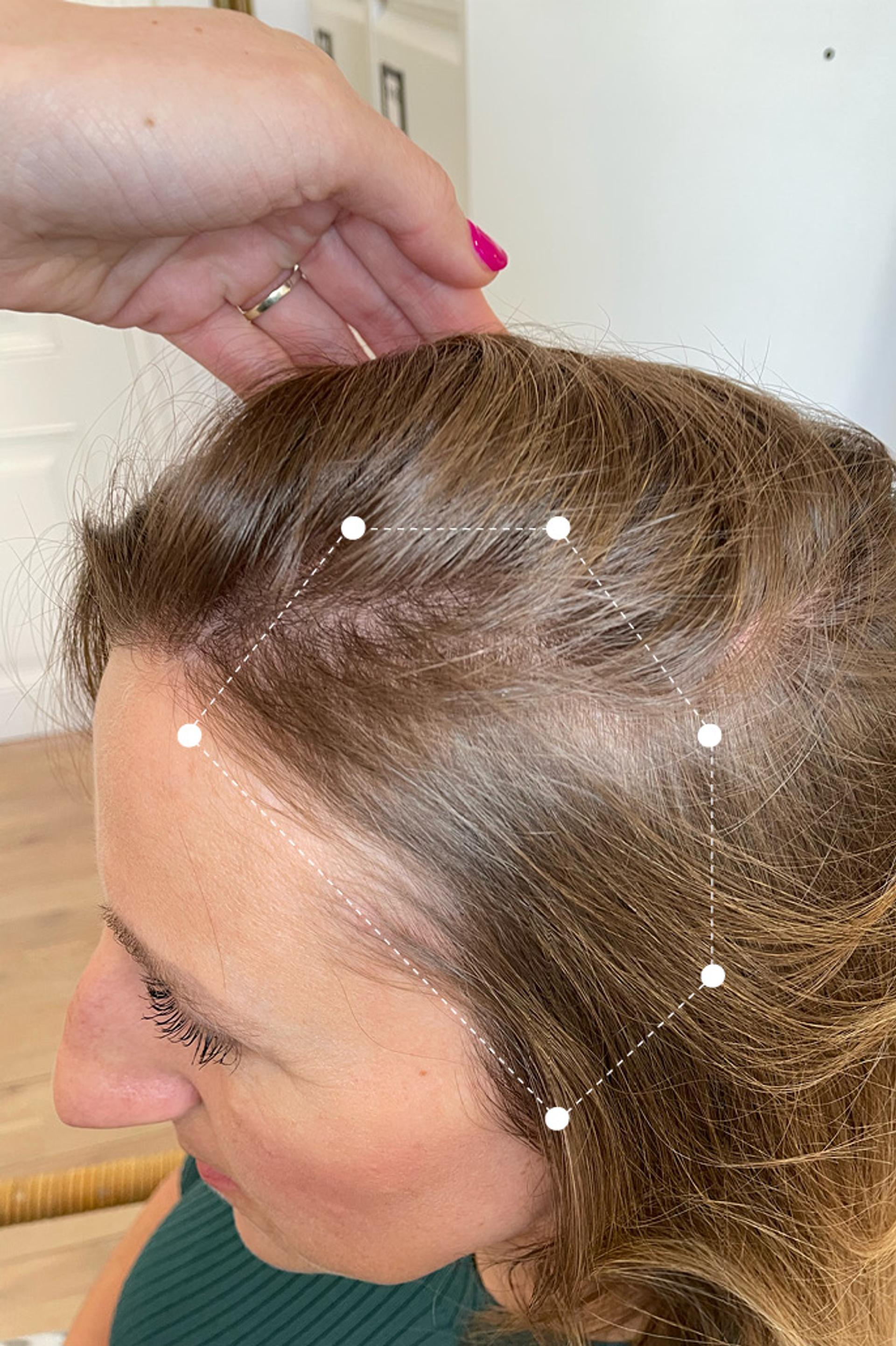 Picture of Temple Hair Thinning on Female Client after using the Harklinikken Extract for 6 months