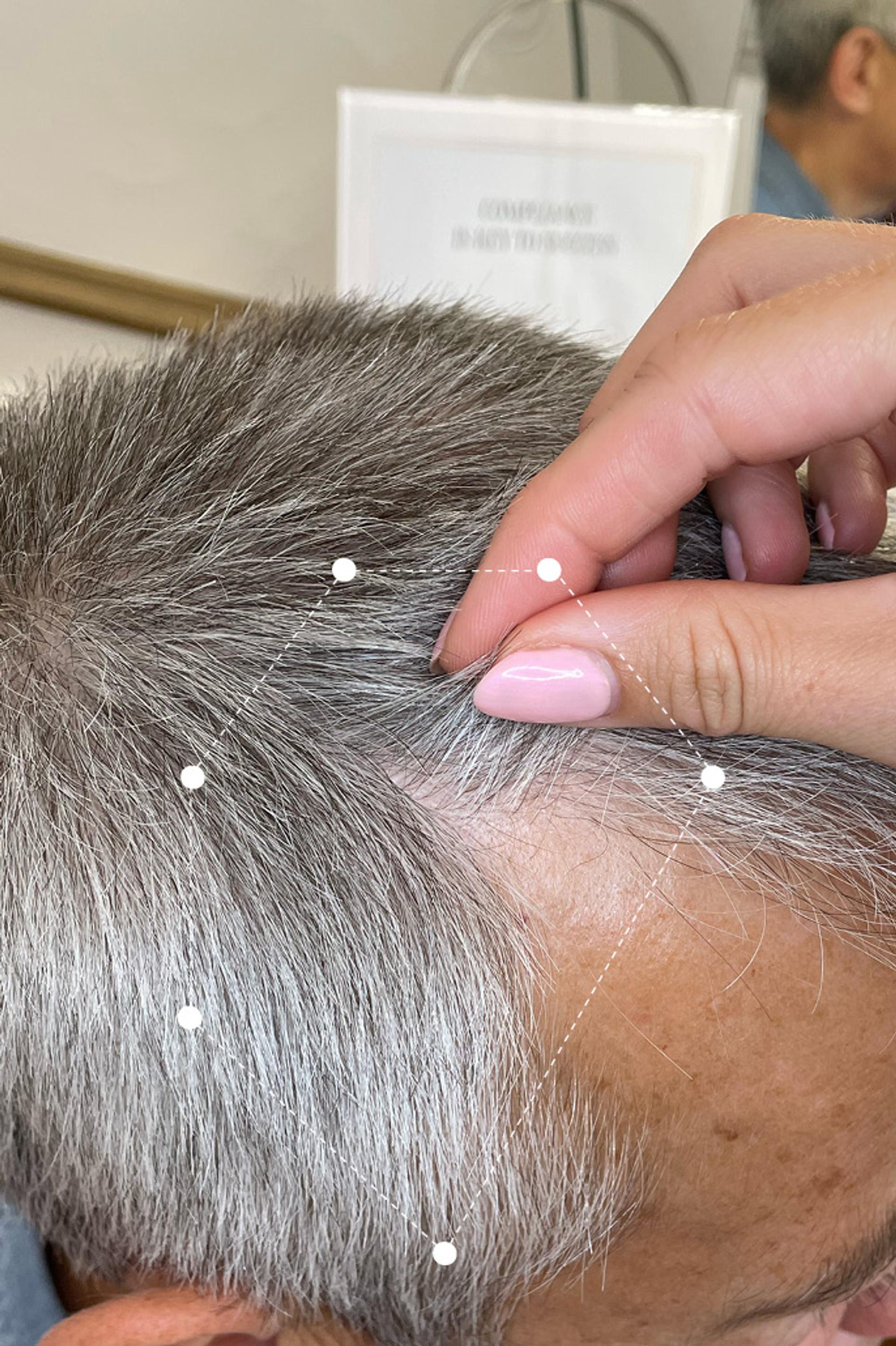 Picture of grey male's side of scalp results before 3 months on extract