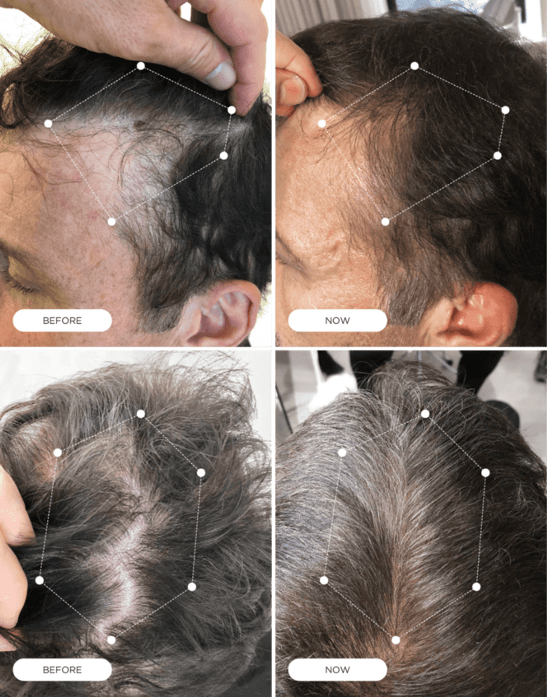 Harklinikken Ambassador Tony Robbins Before and After using the Harklinikken Regimen for Hair Gain