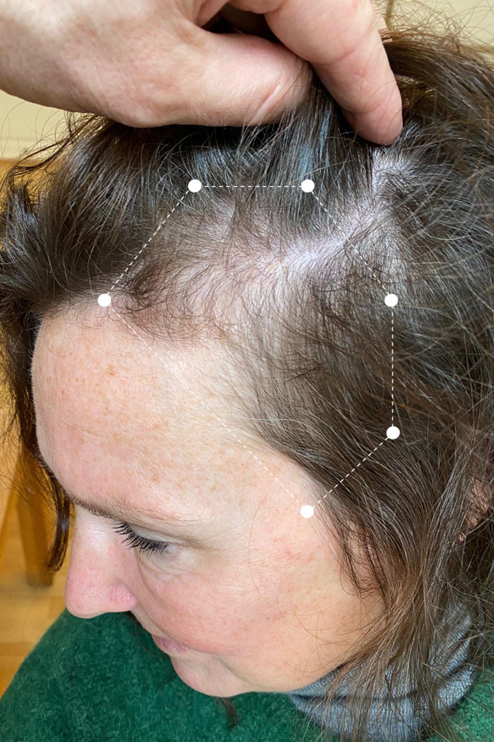 Side of head close up of brunette woman's scalp before going on the Harklinikken Regimen