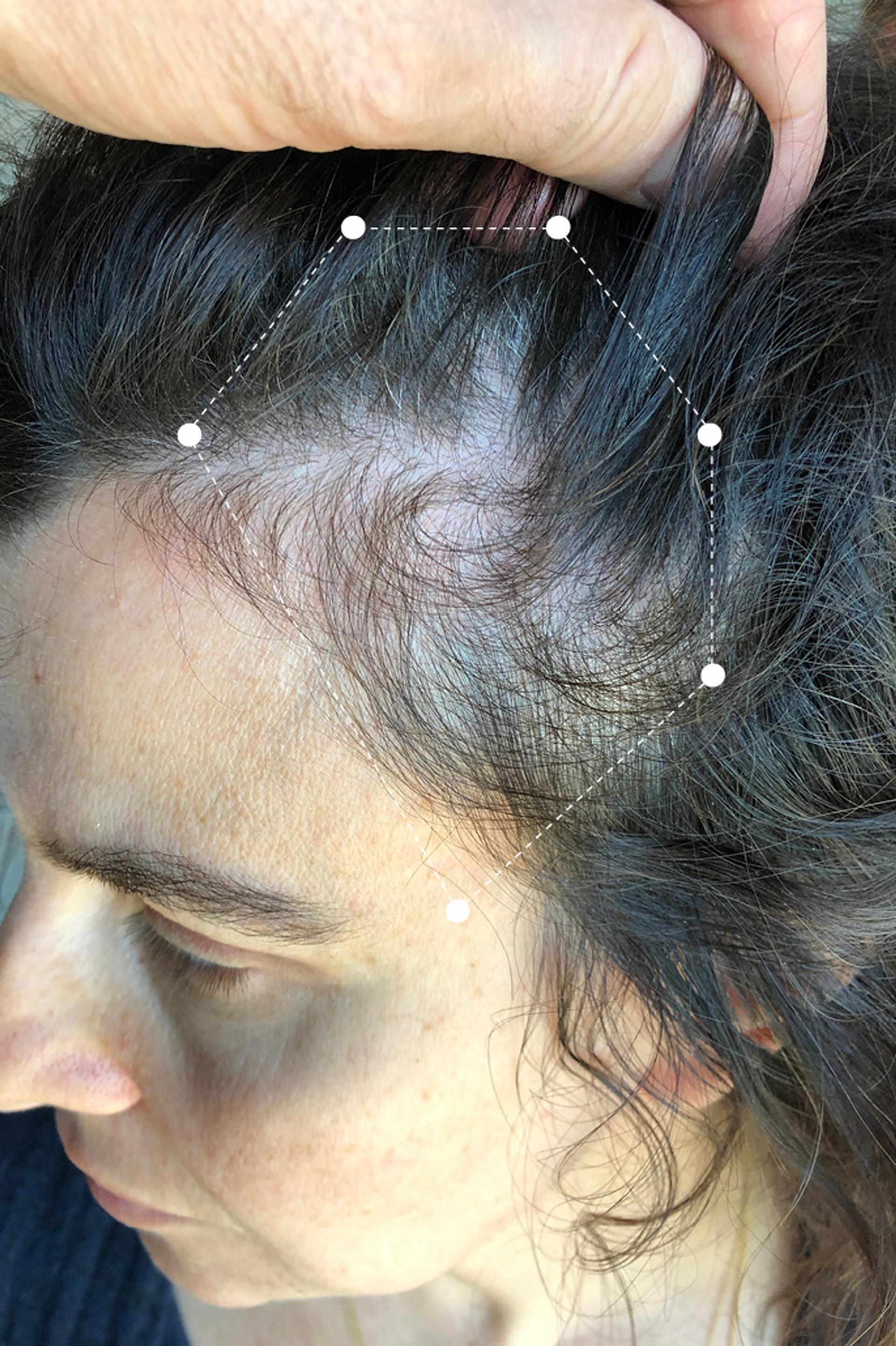 Side of head close up of brown haired woman's full scalp before going on the Harklinikken Regimen